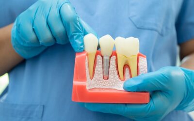Implantes inmediatos: ¿Se puede colocar un diente el mismo día de la extracción?
