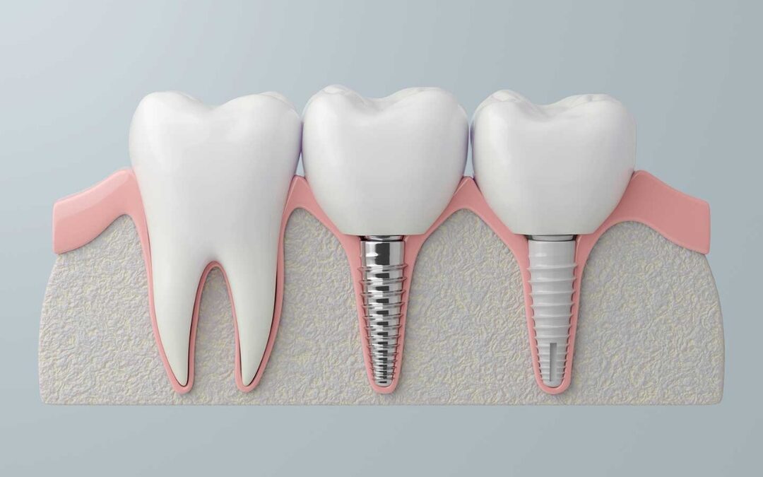 prótesis removibles versus implantes