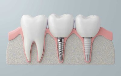 ¿Cuál es el mejor tratamiento tras perder varios dientes? Comparativa y opciones