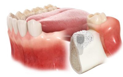 Tu cuerpo, tu mejor aliado: regeneración ósea con hueso propio