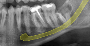 Muelas del juicio y nervio mandibular