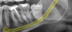 Radiografía inicial coronectomía