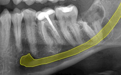Muelas del juicio y nervio mandibular: cuándo elegir la coronectomía