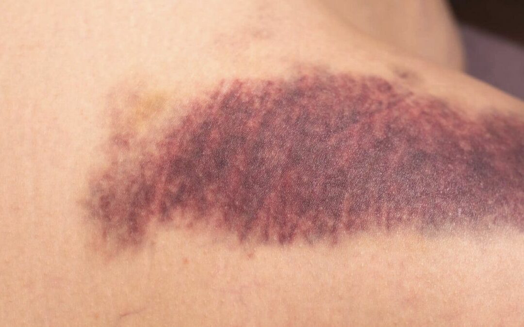 Enfermedad de von Willebrand a los implantes dentales