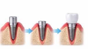 Fases de recuperación tras un implante dental