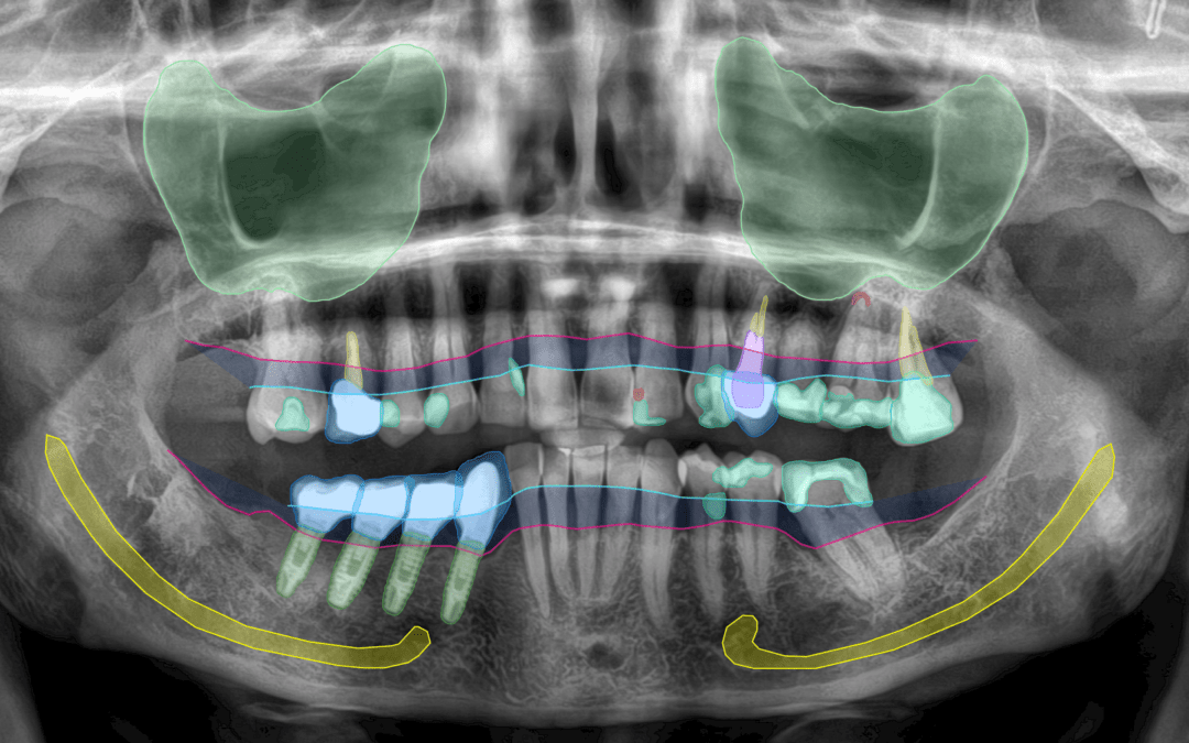 IA para planificar tu tratamiento dental