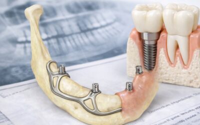 Implantes cortos o implantes subperiósticos: alternativas cuando falta hueso dental