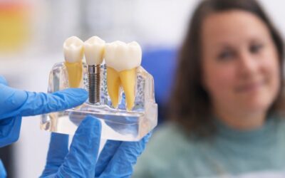¿Es doloroso colocar un implante dental? Qué esperar antes, durante y después