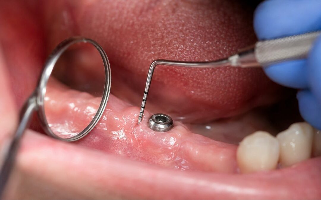 Implantes dentales y salud periodontal