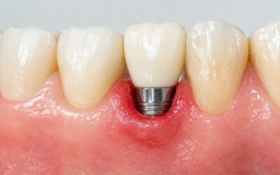 Periimplantitis, la complicación de los implantes dentales de la que conviene hablar más