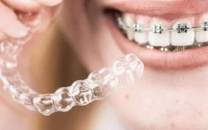 brackets u ortodoncia