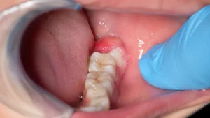 pericoronitis